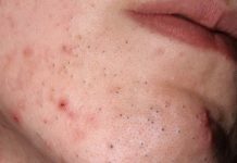 Как избавиться от черных точек, лучшие проверенные средства