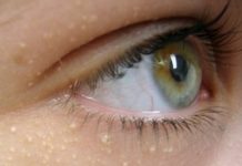 Что лучше: осуществить в домашних условиях лечение липомы или обратиться к доктору