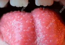 ТОП-5 причин появления сыпи на языке у детей и методы лечения патологии