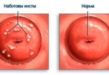 Прыщик на шейке матки — причины и лечение