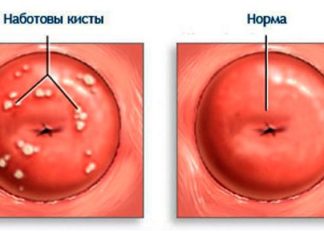 Прыщик на шейке матки — причины и лечение