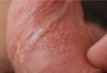 Прыщи на половых органах: чем они вызваны и как их лечить