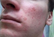 Прыщи из-за гастрита