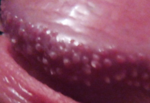 Что делать, если у мужчины на головке появляются прыщи?