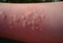 Как быстро вылечить крапивницу у взрослого человека в домашних условиях