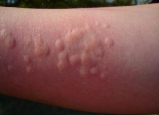 Как быстро вылечить крапивницу у взрослого человека в домашних условиях