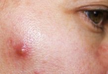 Мазь от прыщей на лице: обзор 20 популярных марок