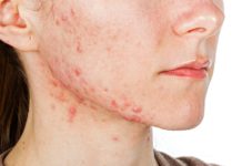 Кожные высыпания на теле взрослого: какие бывают виды сыпи, описание и фото