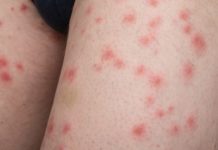 Откуда берётся сыпь на теле и что с этим делать