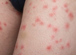 Откуда берётся сыпь на теле и что с этим делать