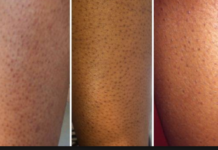 Красные и черные точки после эпиляции и бритья — как избавиться