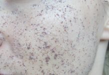 Акне у подростков: лечение, причины, симптомы (фото)