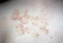 Эритематозная сыпь — Сыпи(высыпания)