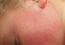 Сыпь при скарлатине: симптоматика, профилактика и лечение