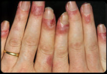 Туберкулез кожи: фото, симптомы, разновидности