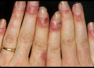 Туберкулез кожи: фото, симптомы, разновидности