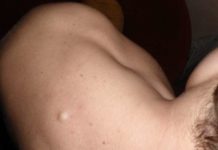 Удаление липомы лазером: особенности терапии, последствия операции |