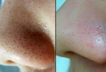 Как быстро убрать черные точки на носу — ликбез для новичков