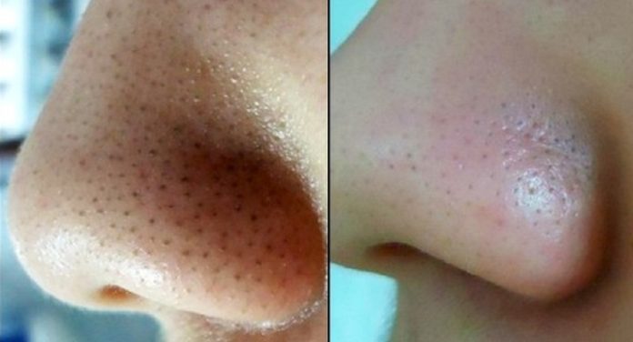 udalenie_chernyh_tochek