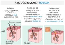 Угревая сыпь у подростков