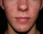 Угревая сыпь — причины, признаки, симптомы и лечение