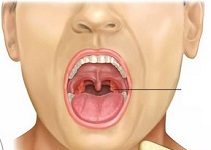 Вирус Эпштейна-Барр, что это такое? Симптоматика и лечение у детей и взрослых