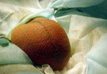 Жировик на члене у мужчины: симптомы, как избавиться