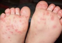 Энтеровирусная экзантема у детей, у взрослых: симптомы и лечение |