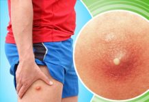 Что делать если прорвался фурункул и чем заживлять рану