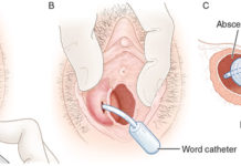 Жировик во влагалище: список симптомов, причины возникновения липомы, лечение, профилактика