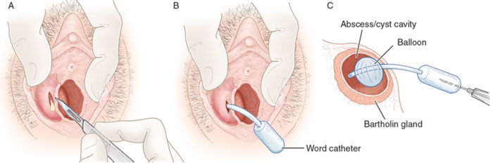 Word-catheter-insertion-procedure