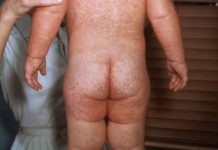 Сыпь у новорожденных, грудничков — причины, лечение высыпаний