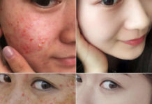 Эфирные масла от прыщей: 10 эффективных масел от прыщей!