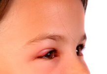 Ячмень на глазу – причины, симптомы и лечение в домашних условиях | Медицина на; Добро ЕСТЬ