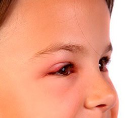 Ячмень на глазу – причины, симптомы и лечение в домашних условиях | Медицина на; Добро ЕСТЬ