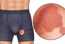 Почему чешется мошонка и зудят яички у мужчин — причины, чем лечить и мазать