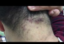 Гнойники на голове в волосах: причины прыщей у мужчин и женщин