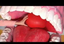 Абсцесс – симптомы, лечение, вскрытие, удаление, диагностика, причины