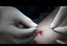 Болит жировик при надавливании: причины и борьба с воспалением