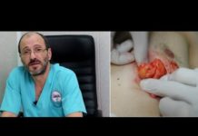 Атерома или липома: разница и как определить образование