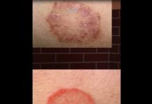 Чешутся локти: причины и лечение зуда, сыпи, покраснения