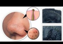 Черные угри (точки) — от чего появляются, как избавиться на лице и спине, способы лечения