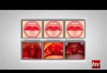 Гнойный тонзиллит: лечение в домашних условиях, фото, симптомы