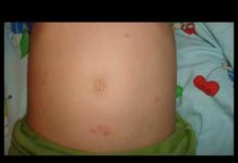 Сыпь как комариные укусы — фото, причины у взрослых, как лечить