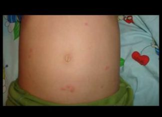 Сыпь как комариные укусы — фото, причины у взрослых, как лечить