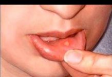 Прыщ внутри губы: почему появляется и как лечить
