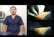 Можно ли удалить жировик жидким азотом