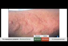 Аллергия на апельсины: симптомы у детей и взрослых, фото