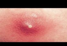 Фурункул на лице: как лечить и убрать чирей