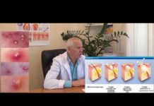 Сколько зреет фурункул и как понять что чирей проходит